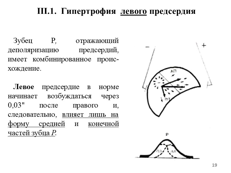 III.1. Гипертрофия левого предсердия Зубец Р, отражающий деполяризацию предсердий, имеет комбинированное проис-хождение. III.1. Гипертрофия левого предсердия Зубец Р, отражающий деполяризацию предсердий, имеет комбинированное проис-хождение.